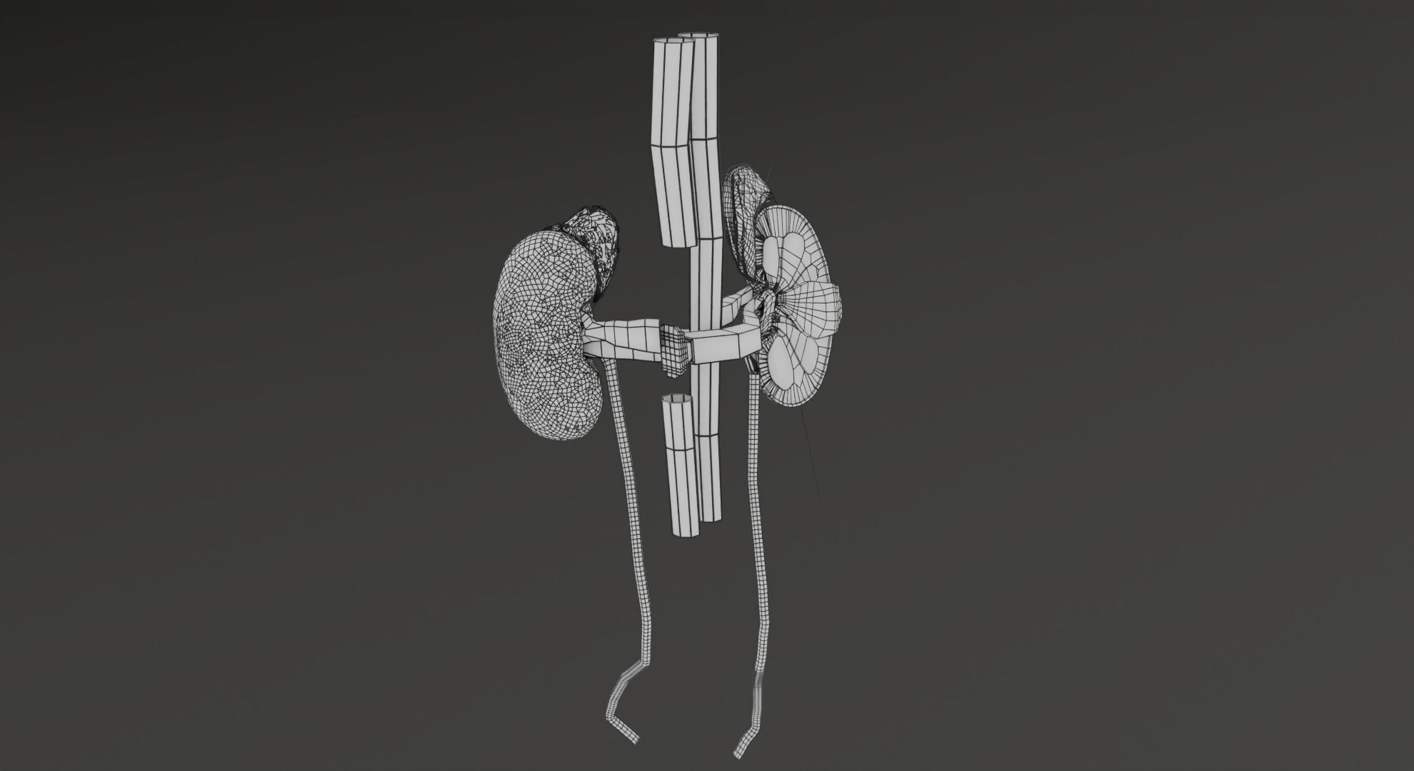 Renal cell carcinoma 3D model_35