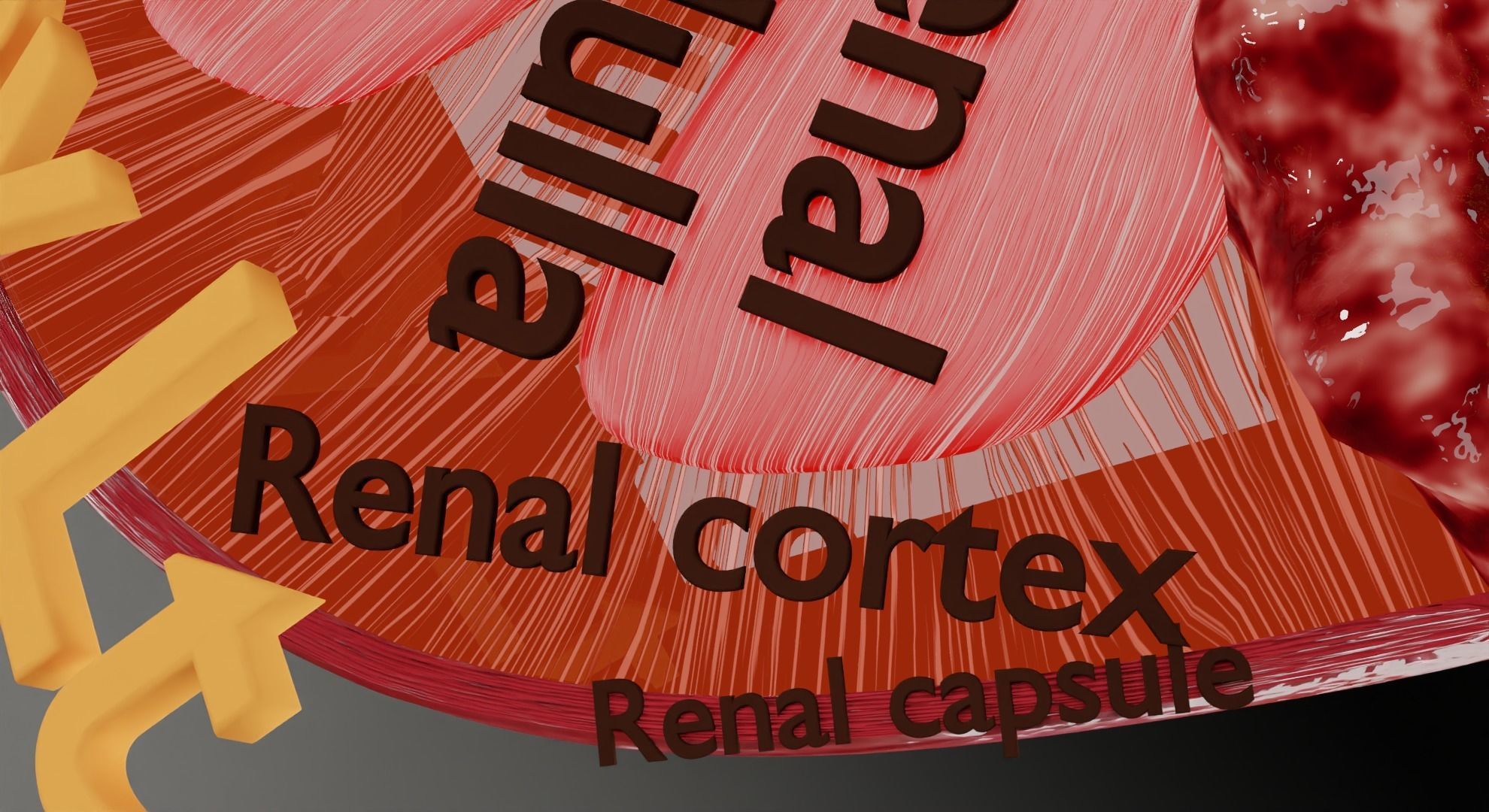 Renal cell carcinoma 3D model_6