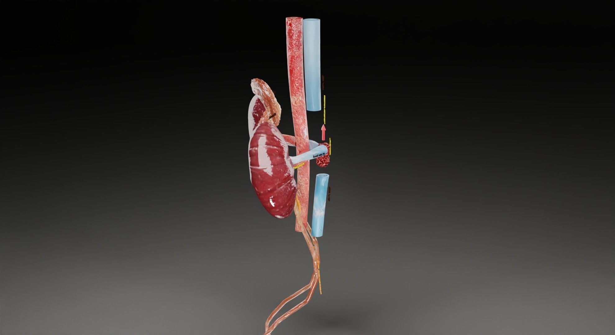 Renal cell carcinoma 3D model_41