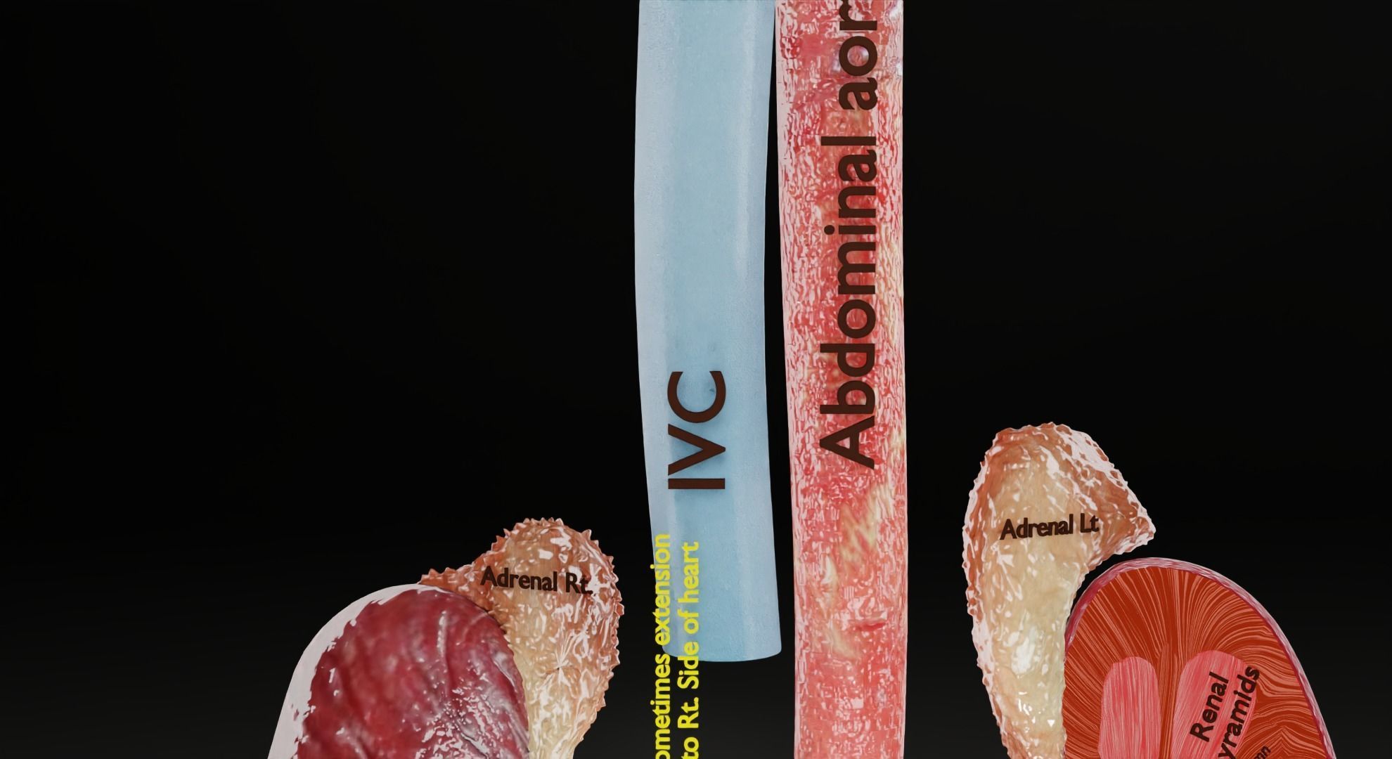 Renal cell carcinoma 3D model_20