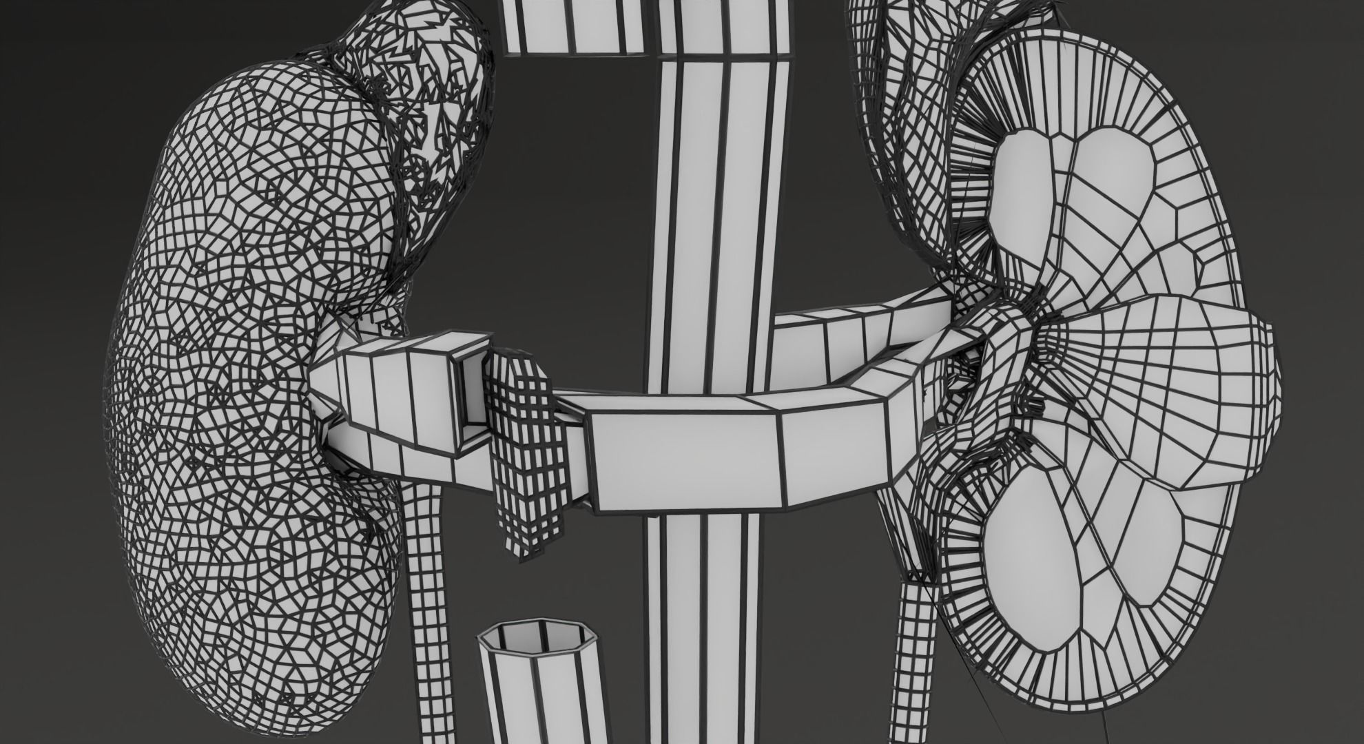 Renal cell carcinoma 3D model_29
