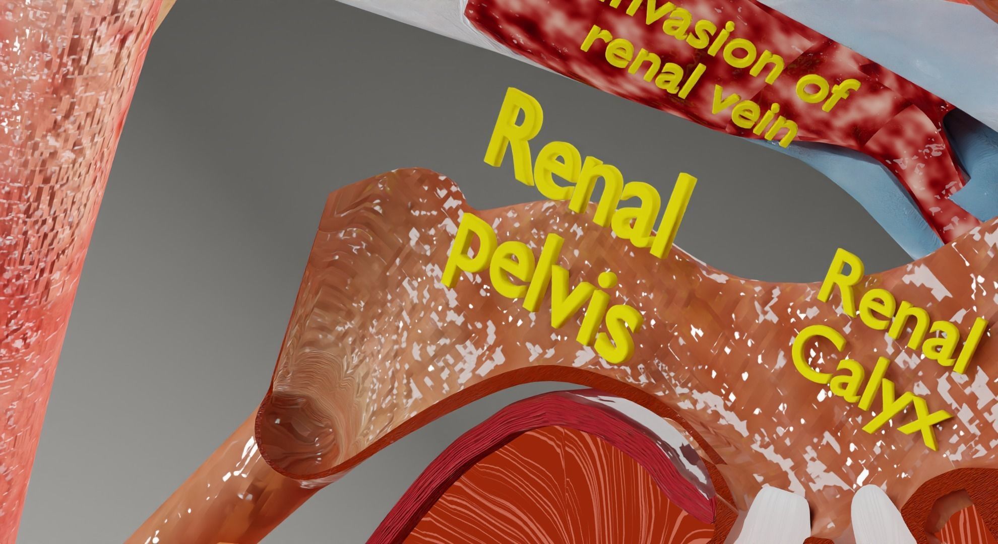 Renal cell carcinoma 3D model_14