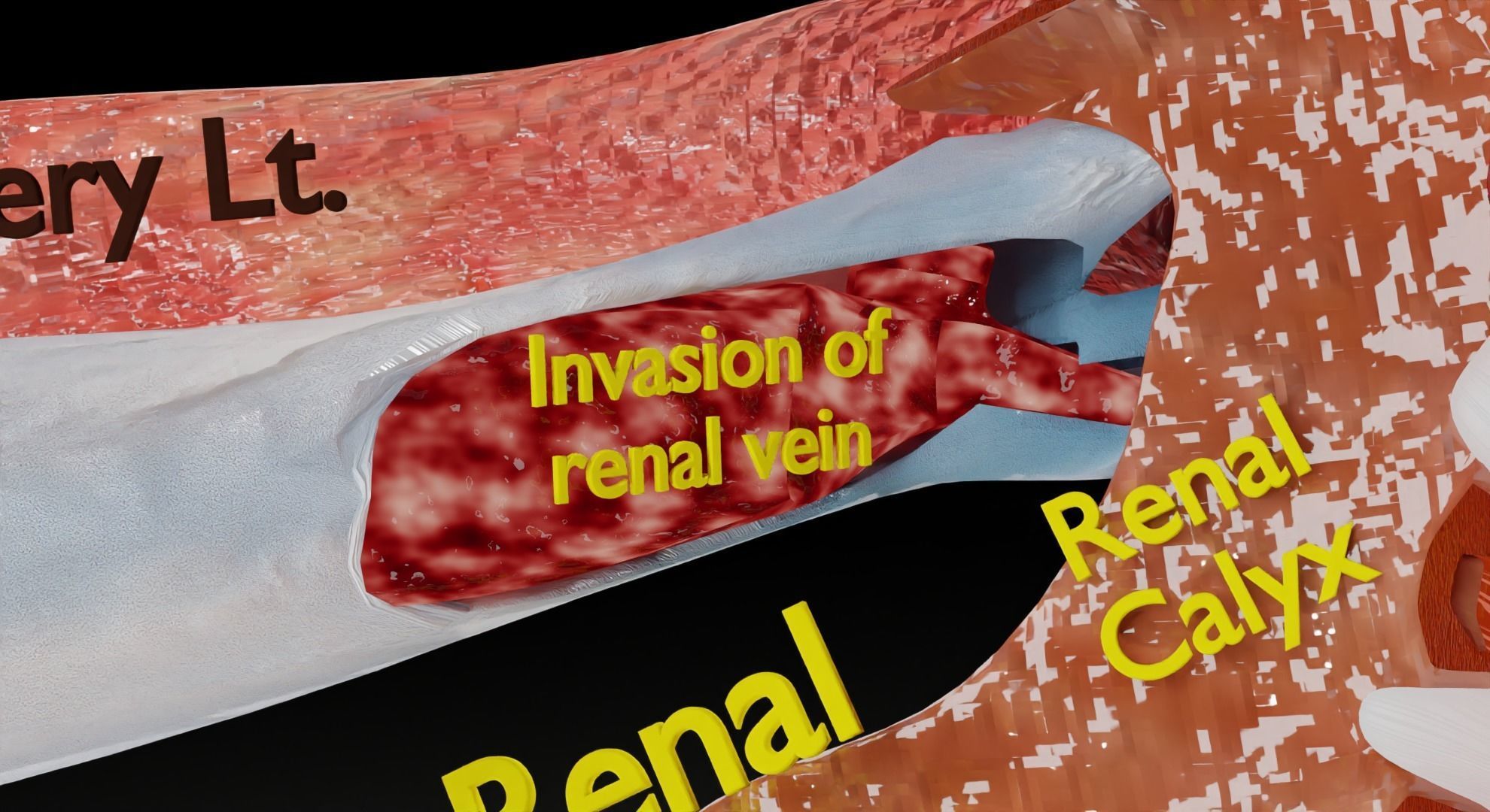 Renal cell carcinoma 3D model_13