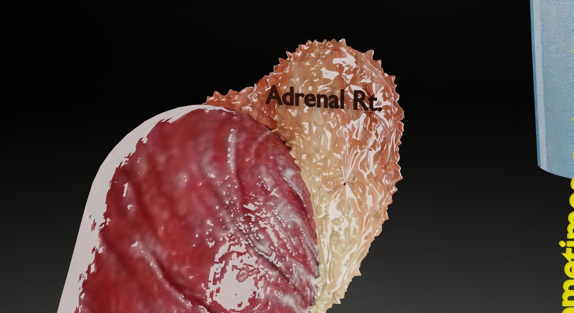 Renal cell carcinoma 3D model_8