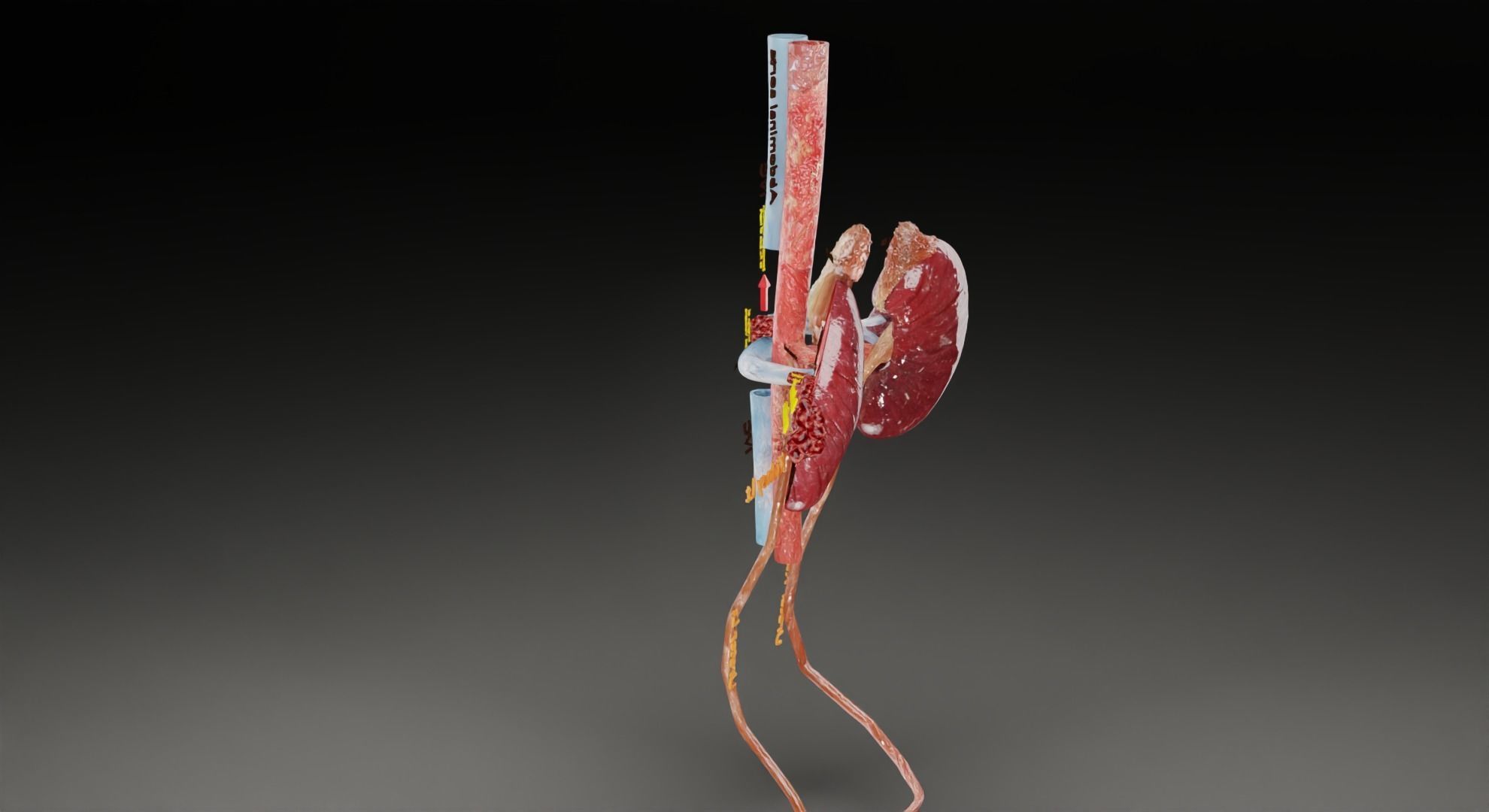 Renal cell carcinoma 3D model_45