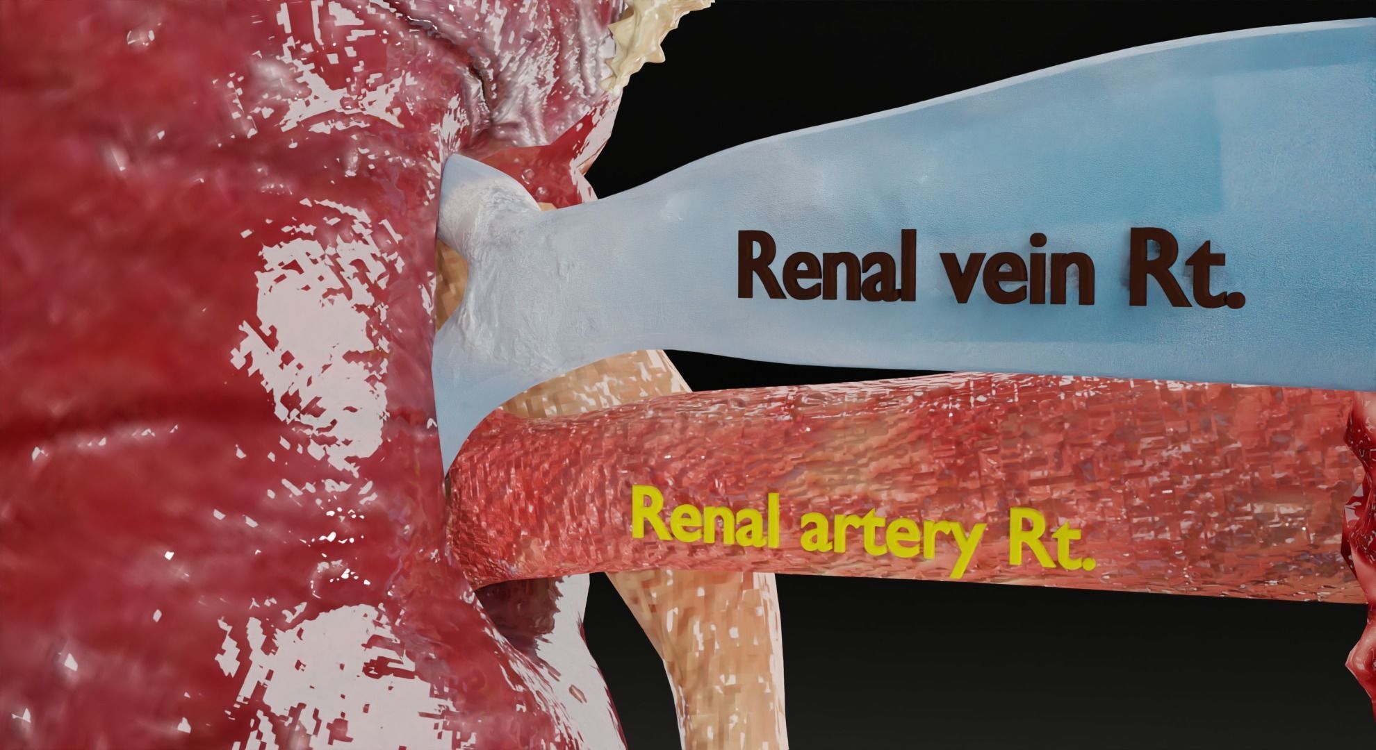 Renal cell carcinoma 3D model_5