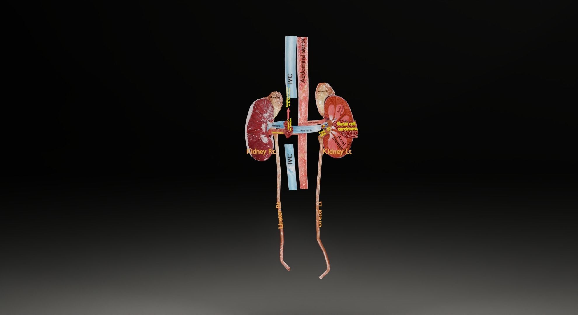 Renal cell carcinoma 3D model_19