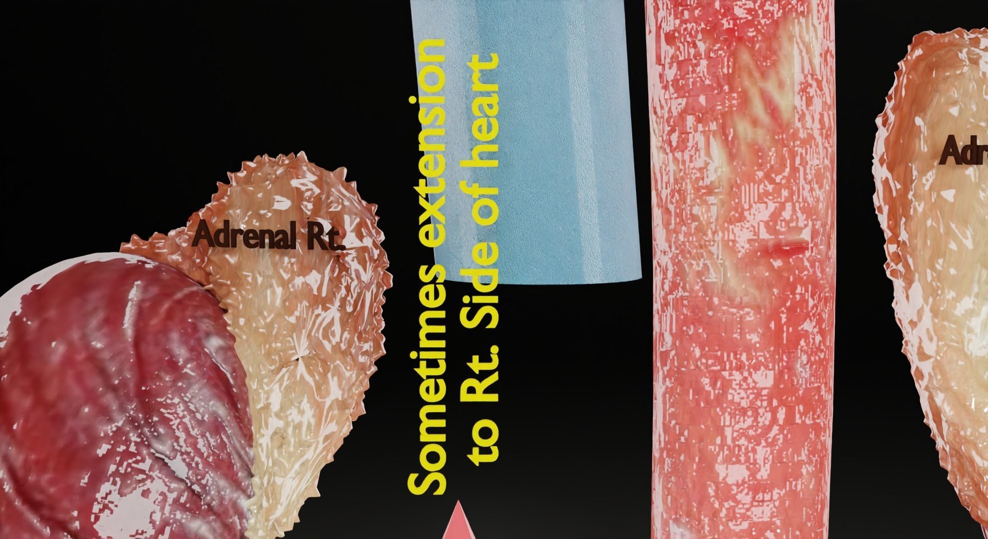 Renal cell carcinoma 3D model_23