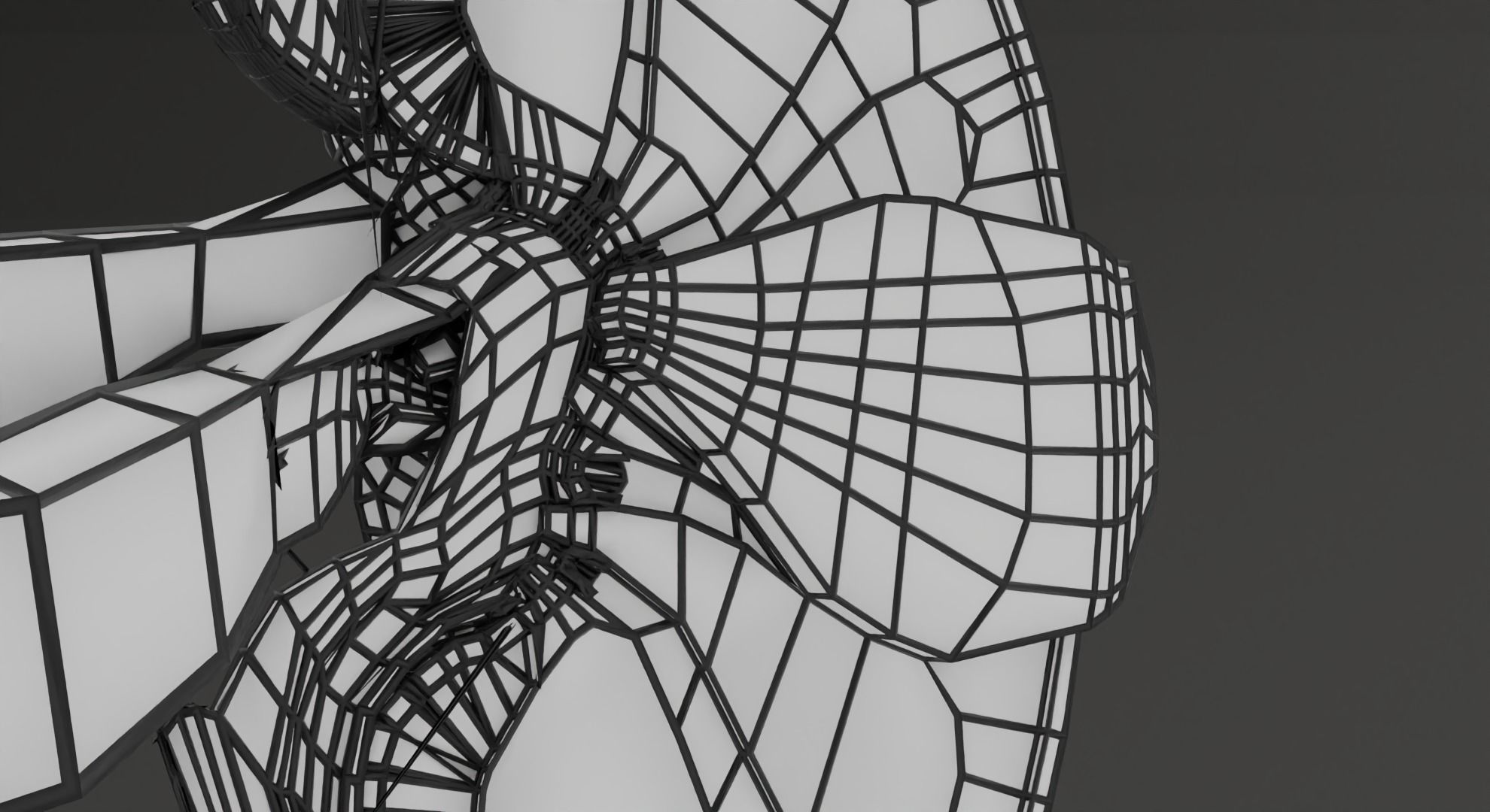 Renal cell carcinoma 3D model_39