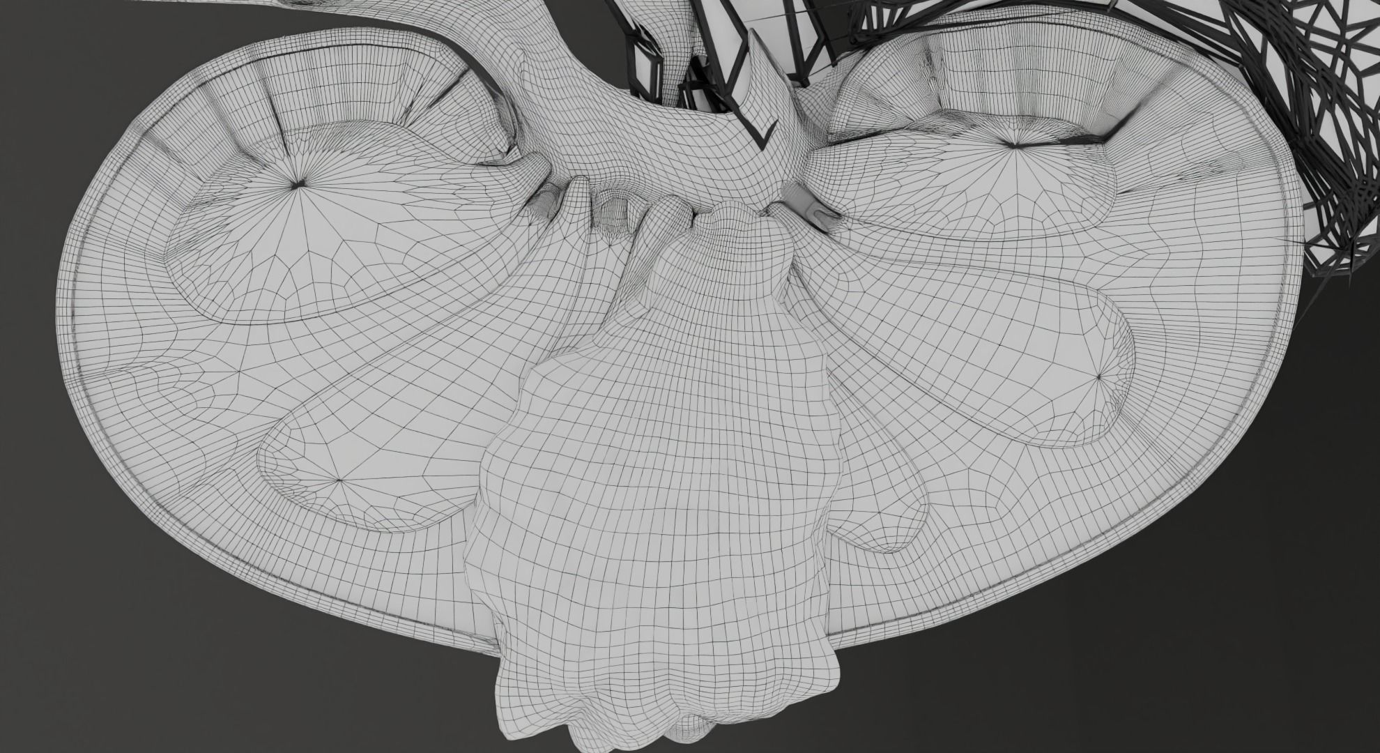 Renal cell carcinoma 3D model_32