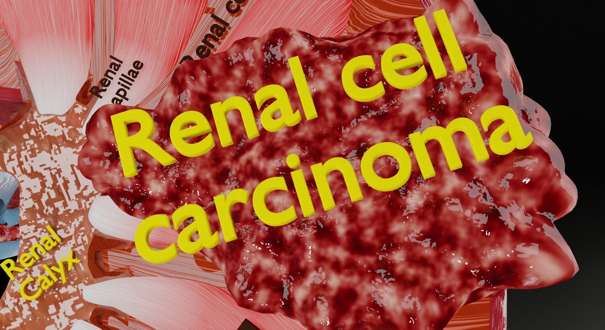 Renal cell carcinoma 3D model_2