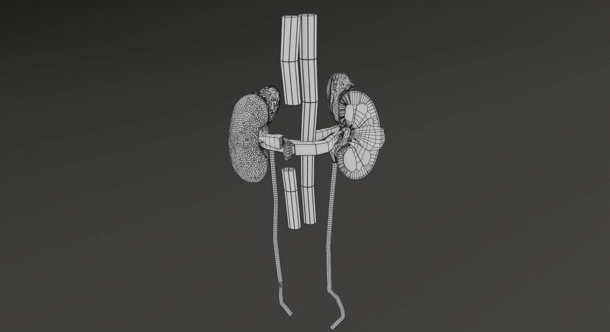 Renal cell carcinoma 3D model_26