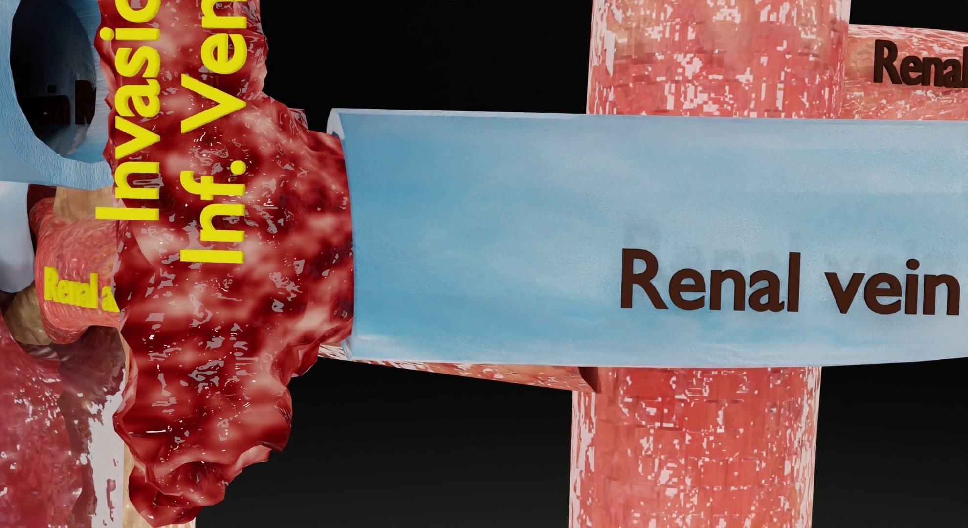 Renal cell carcinoma 3D model_21