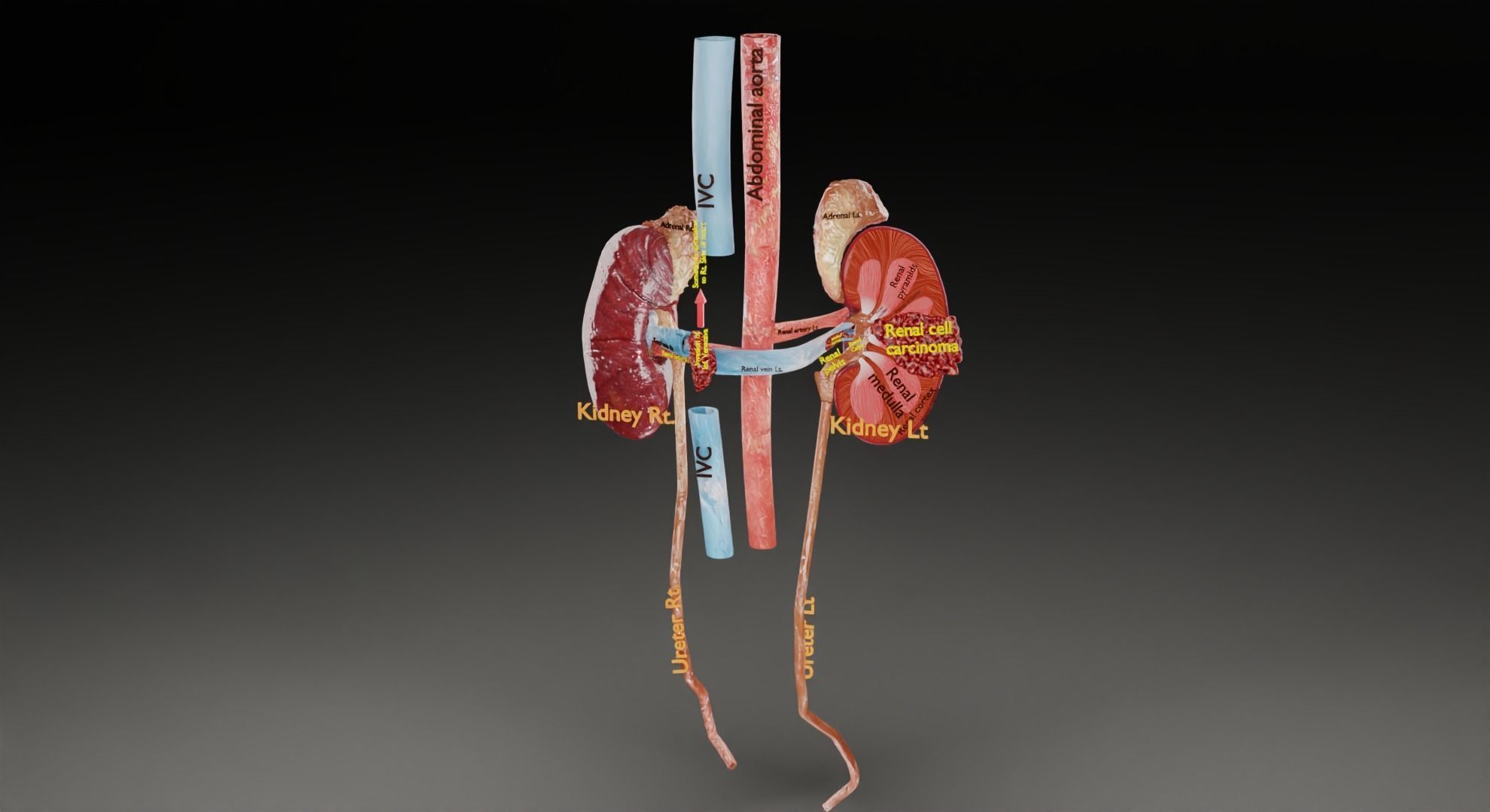 Renal cell carcinoma 3D model_43