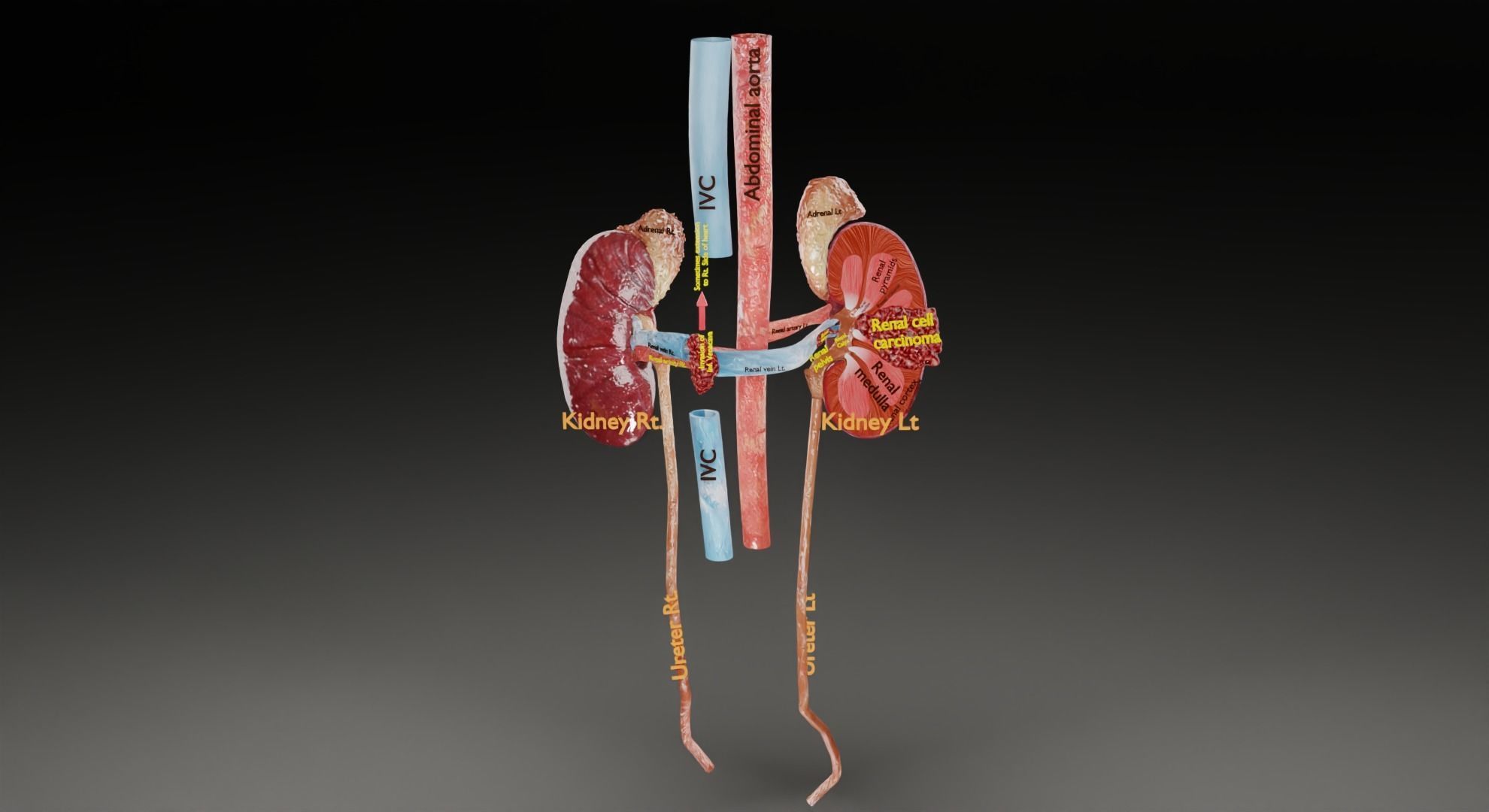 Renal cell carcinoma 3D model_40