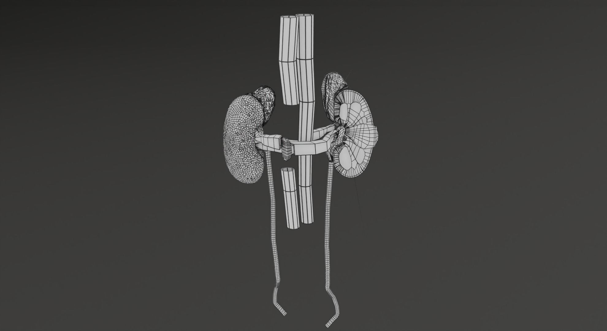 Renal cell carcinoma 3D model_34