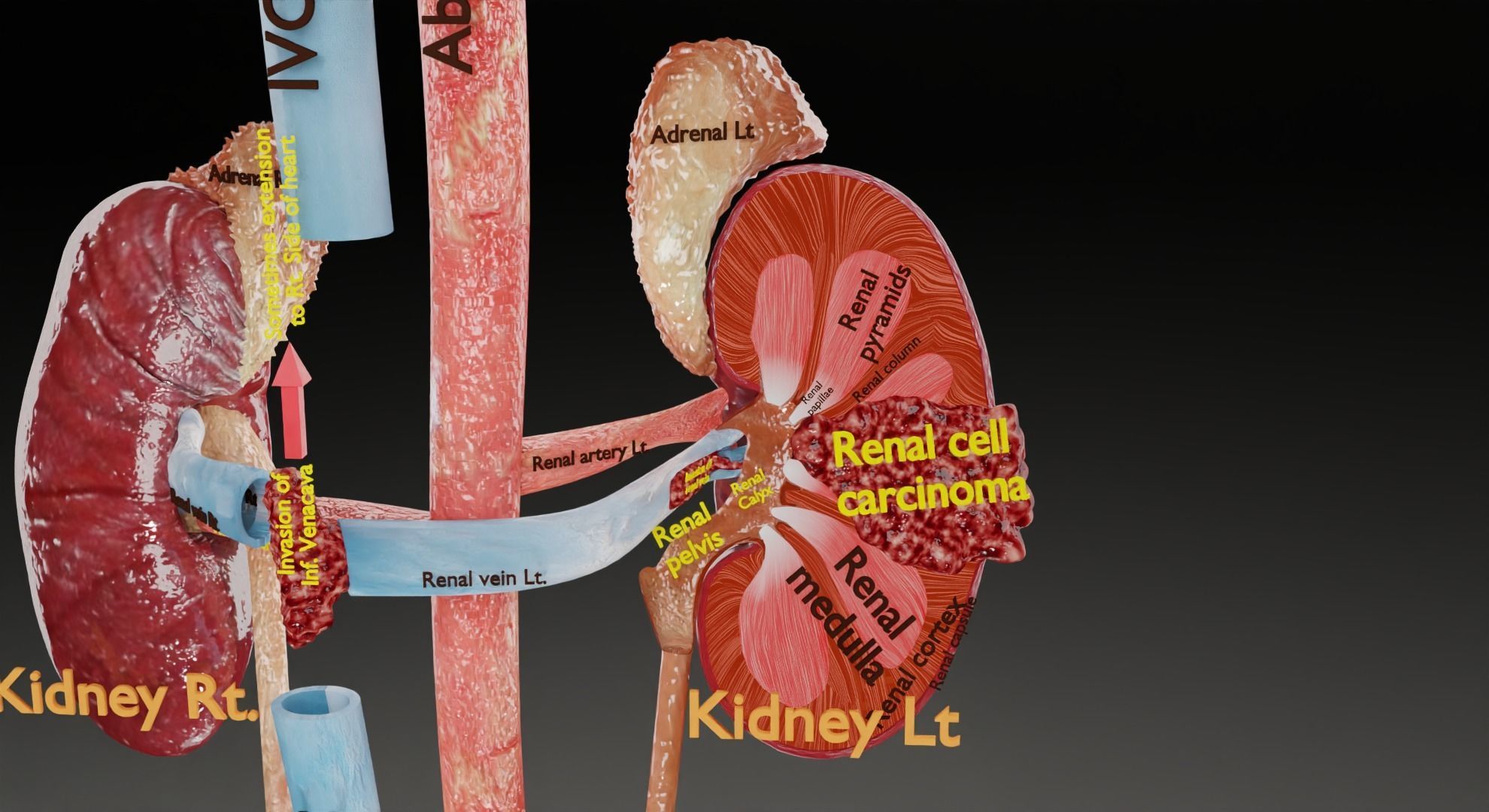 Renal cell carcinoma 3D model_24