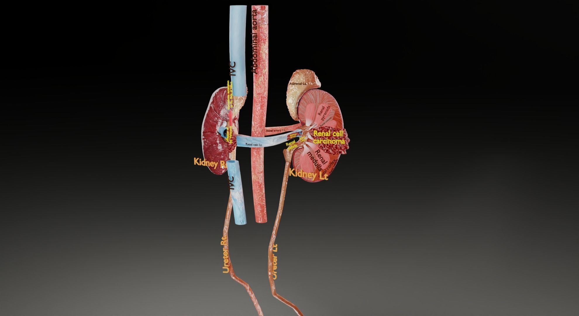 Renal cell carcinoma 3D model_16
