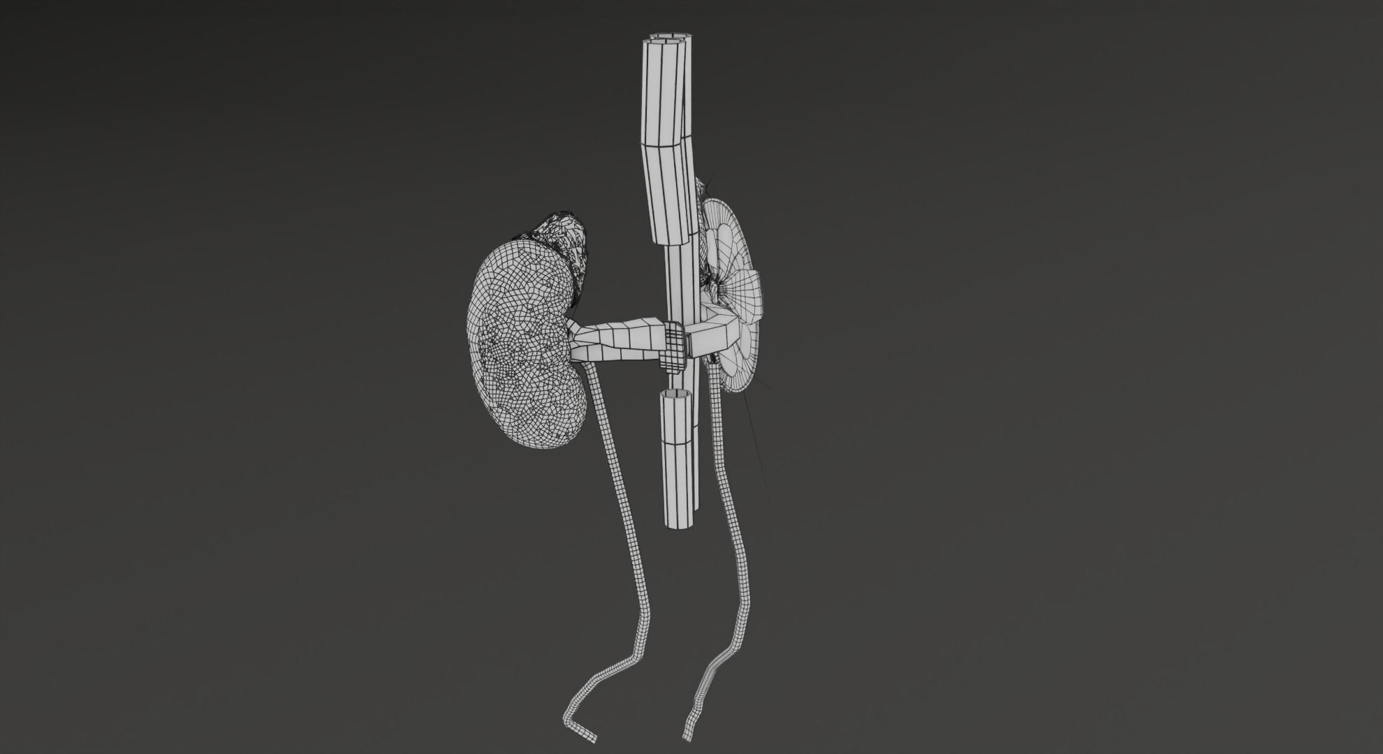 Renal cell carcinoma 3D model_30
