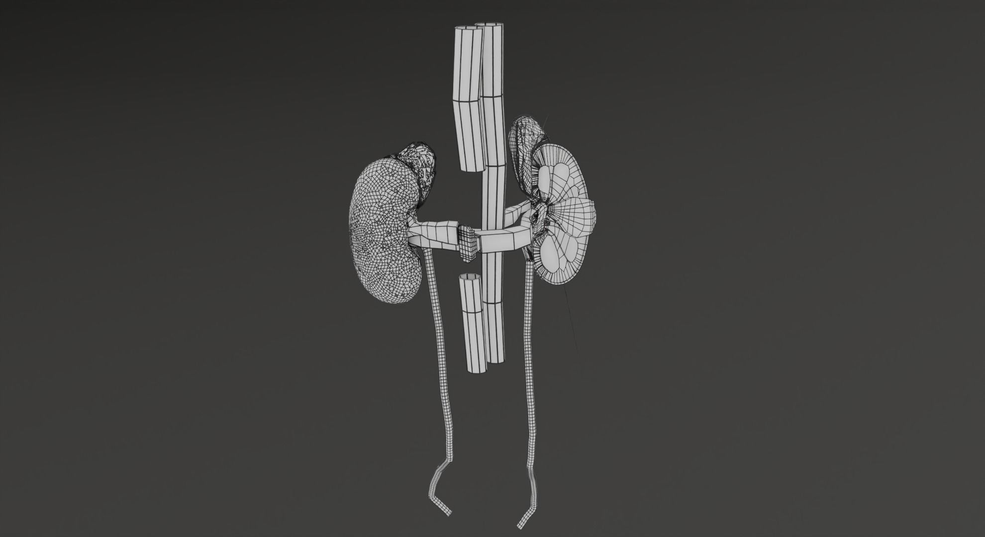 Renal cell carcinoma 3D model_37