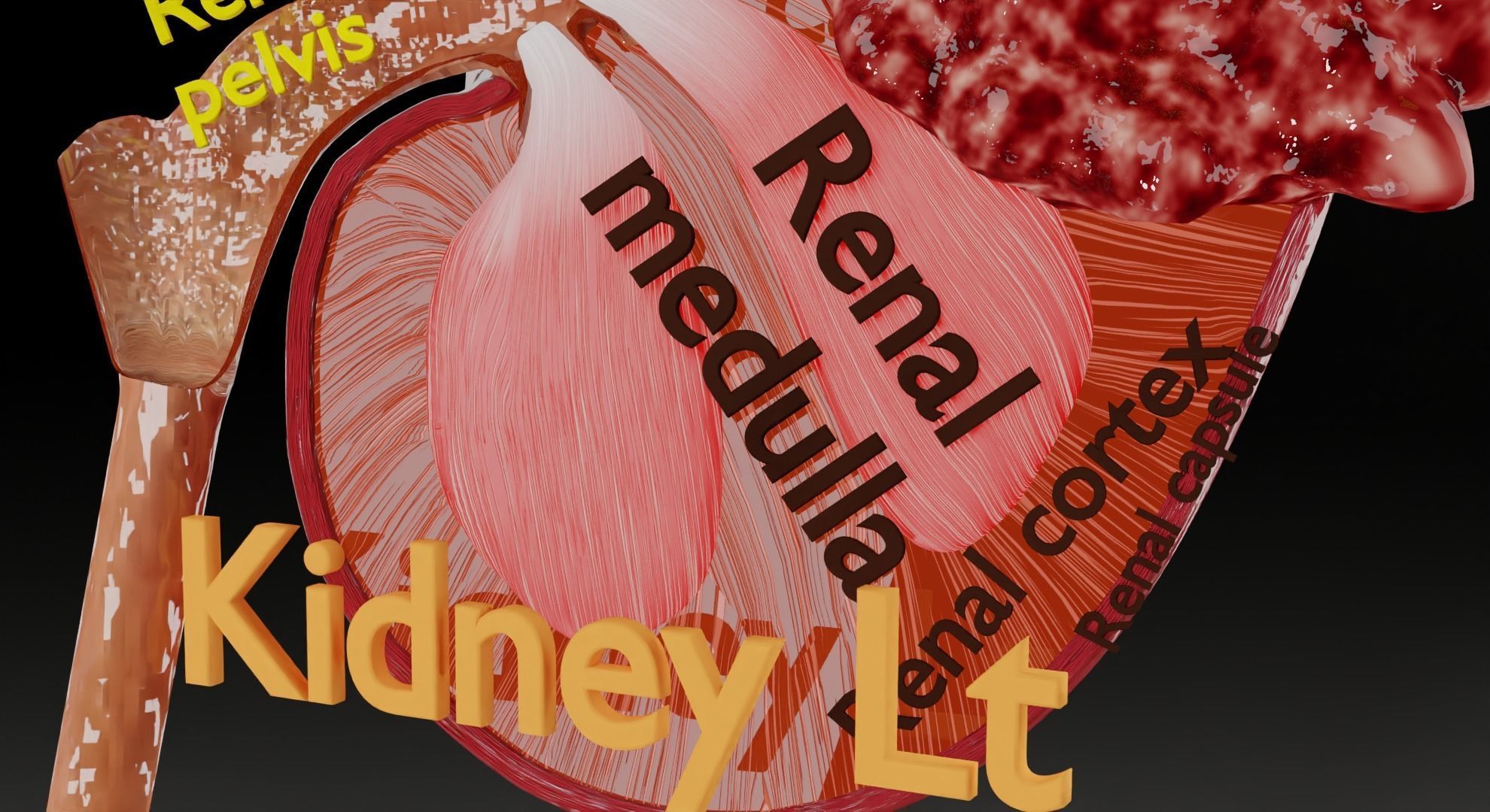 Renal cell carcinoma 3D model_12