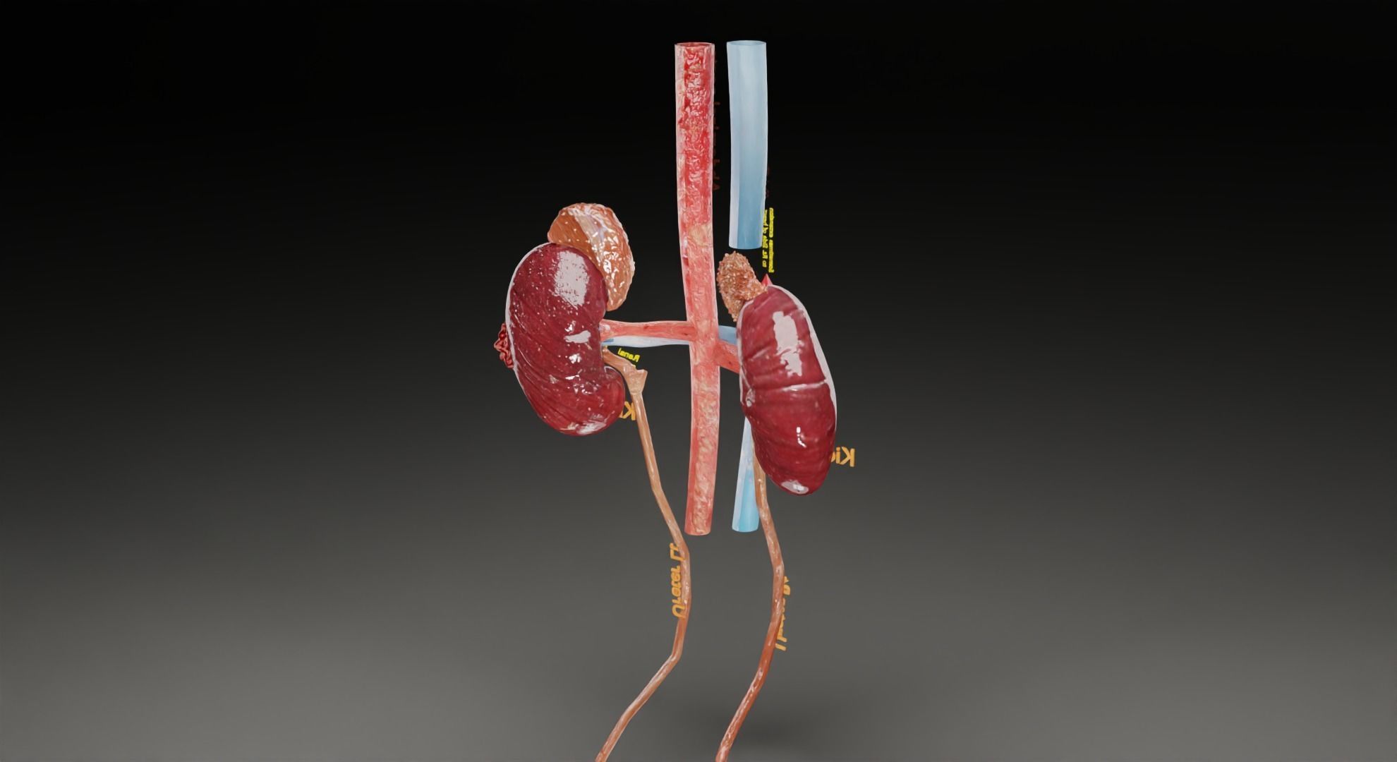Renal cell carcinoma 3D model_44