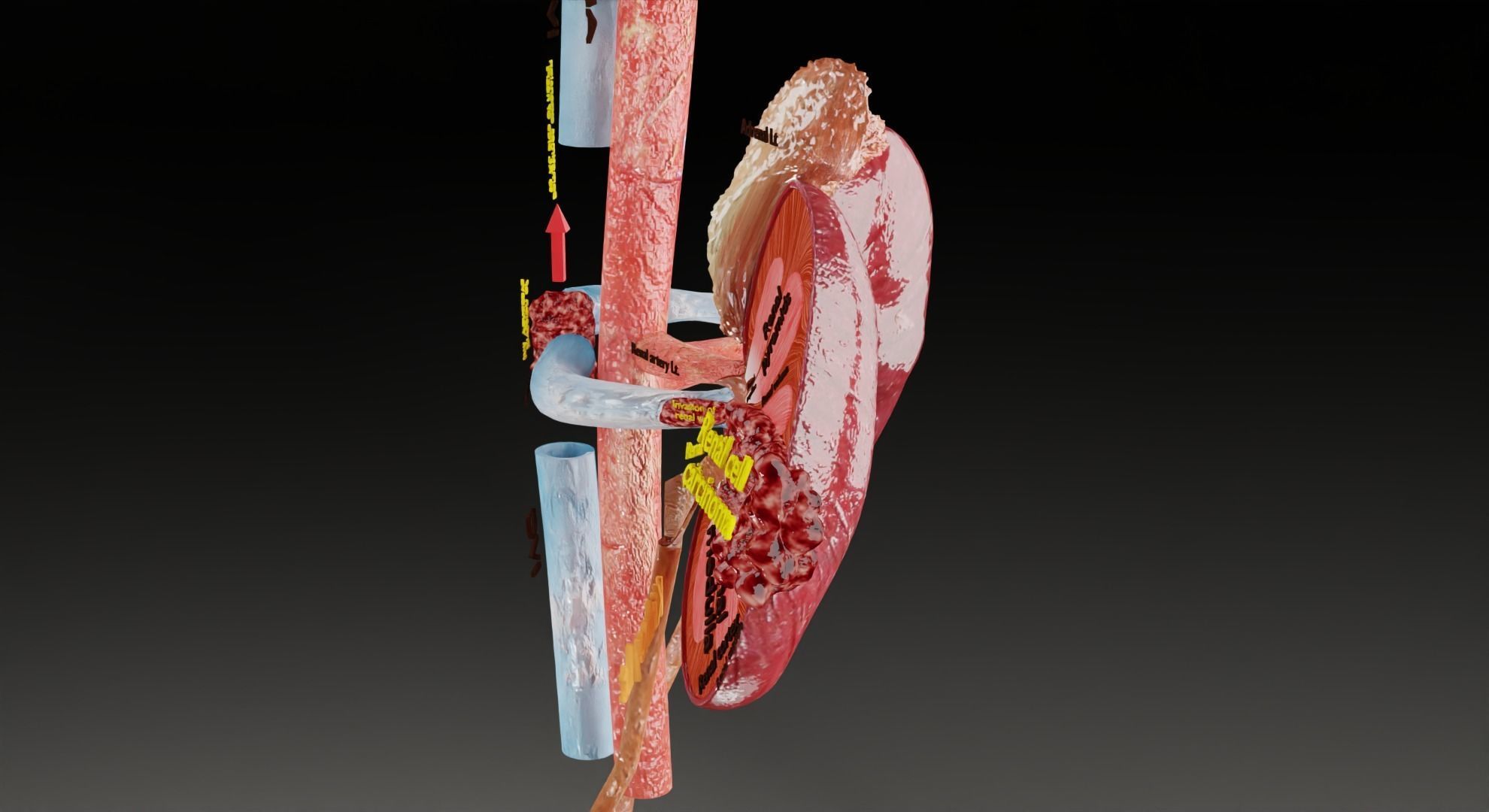 Renal cell carcinoma 3D model_4