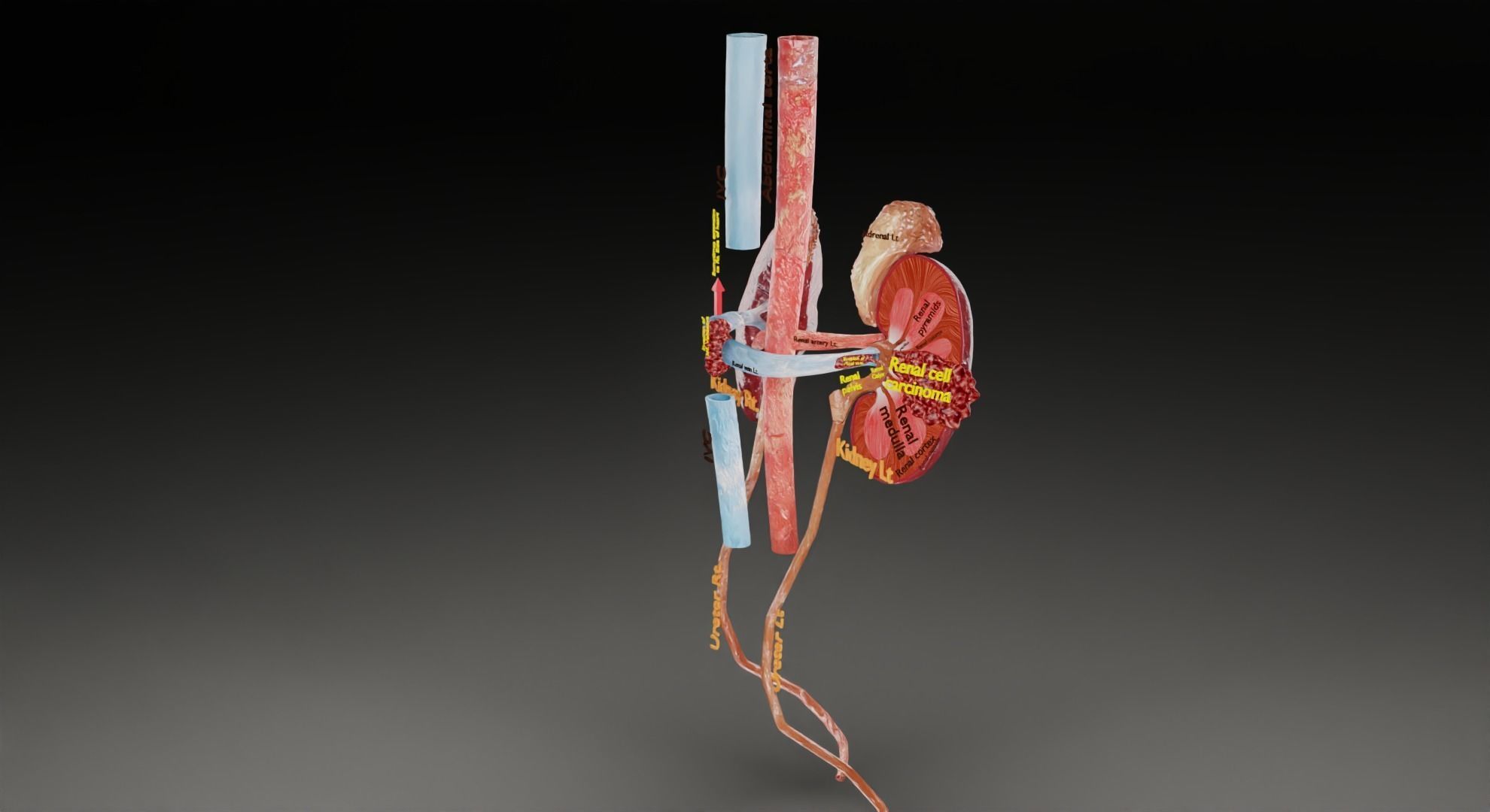 Renal cell carcinoma 3D model_47