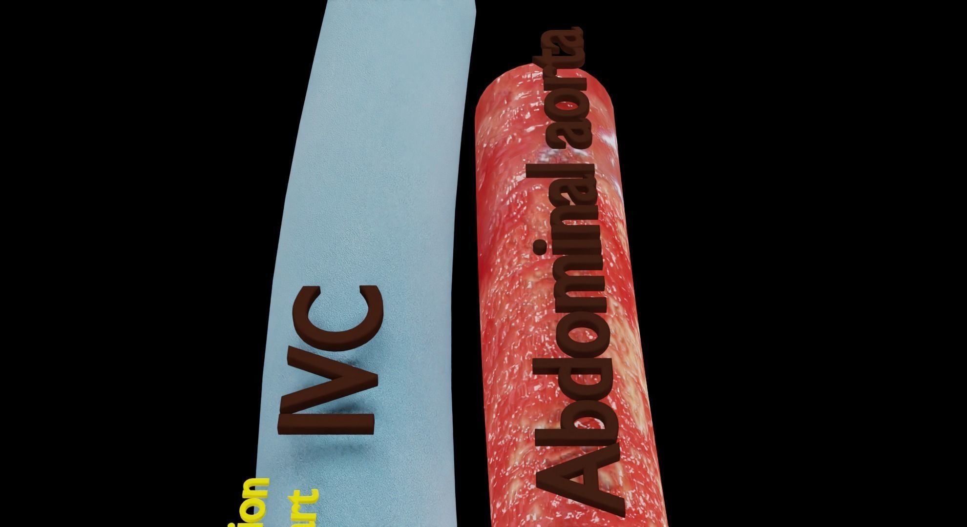 Renal cell carcinoma 3D model_18