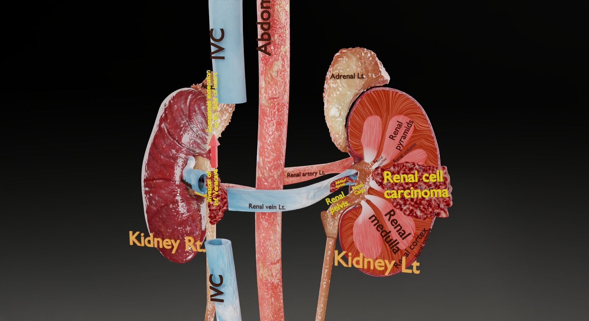 Renal cell carcinoma 3D model_10