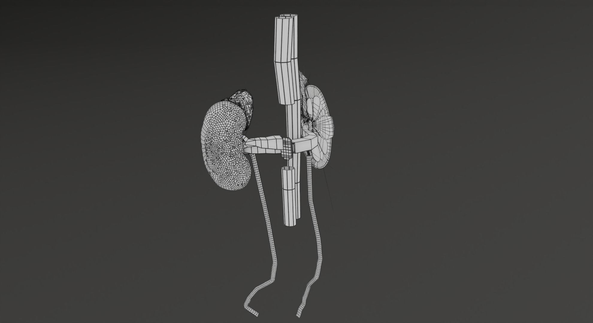 Renal cell carcinoma 3D model_31