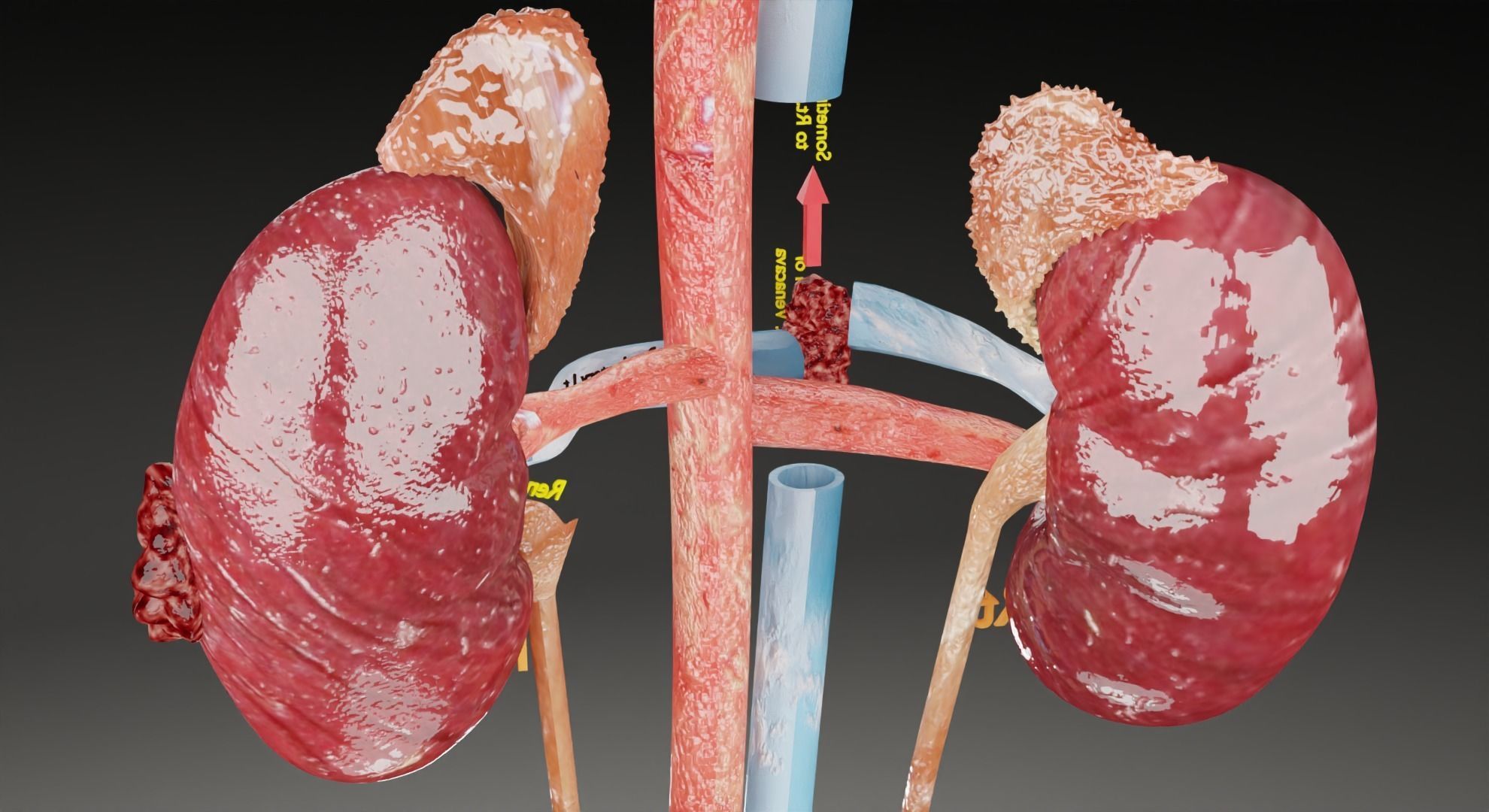 Renal cell carcinoma 3D model_7