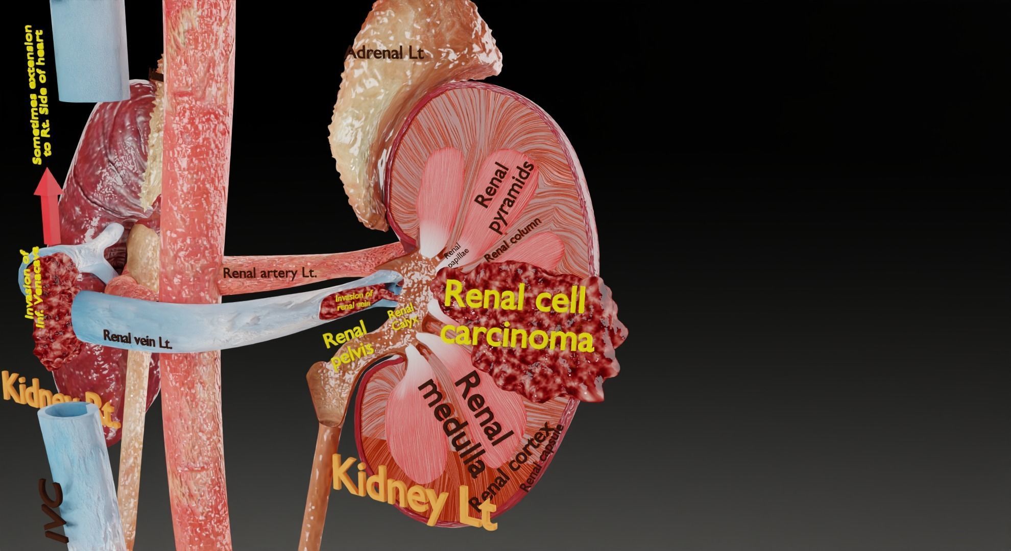 Renal cell carcinoma 3D model_11