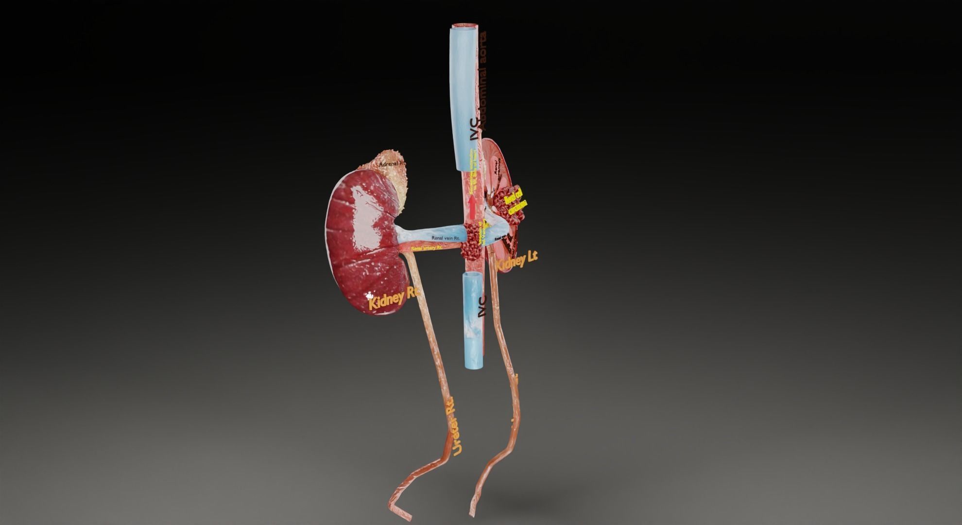 Renal cell carcinoma 3D model_38
