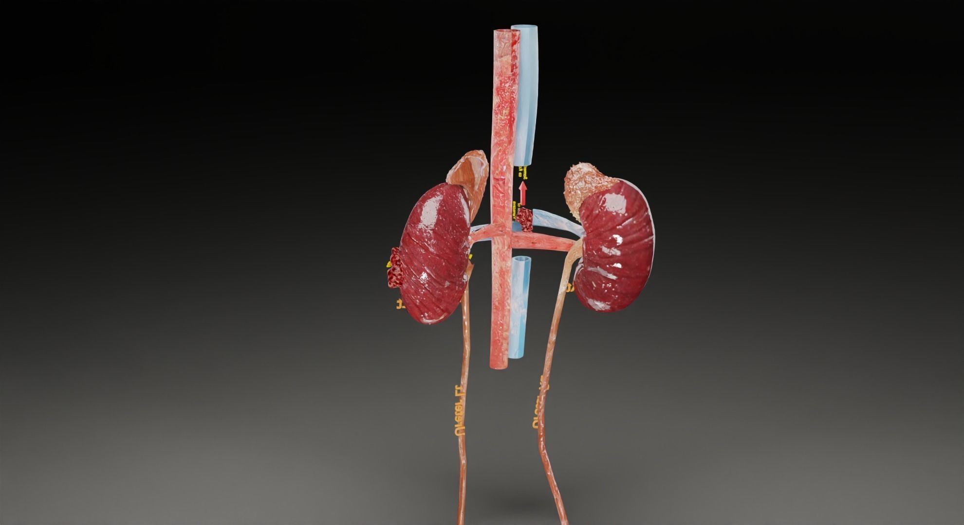 Renal cell carcinoma 3D model_46