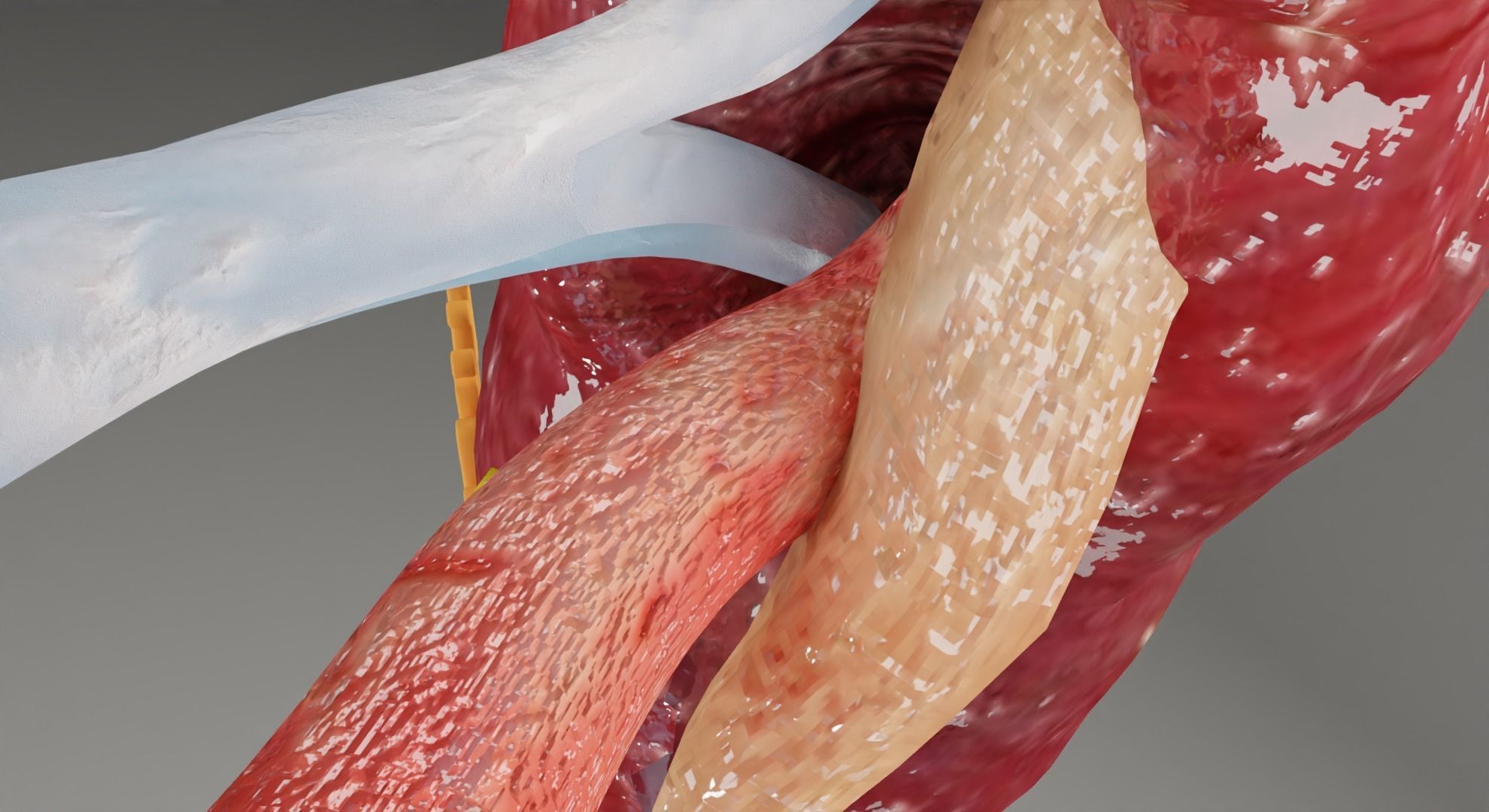 Renal cell carcinoma 3D model_9