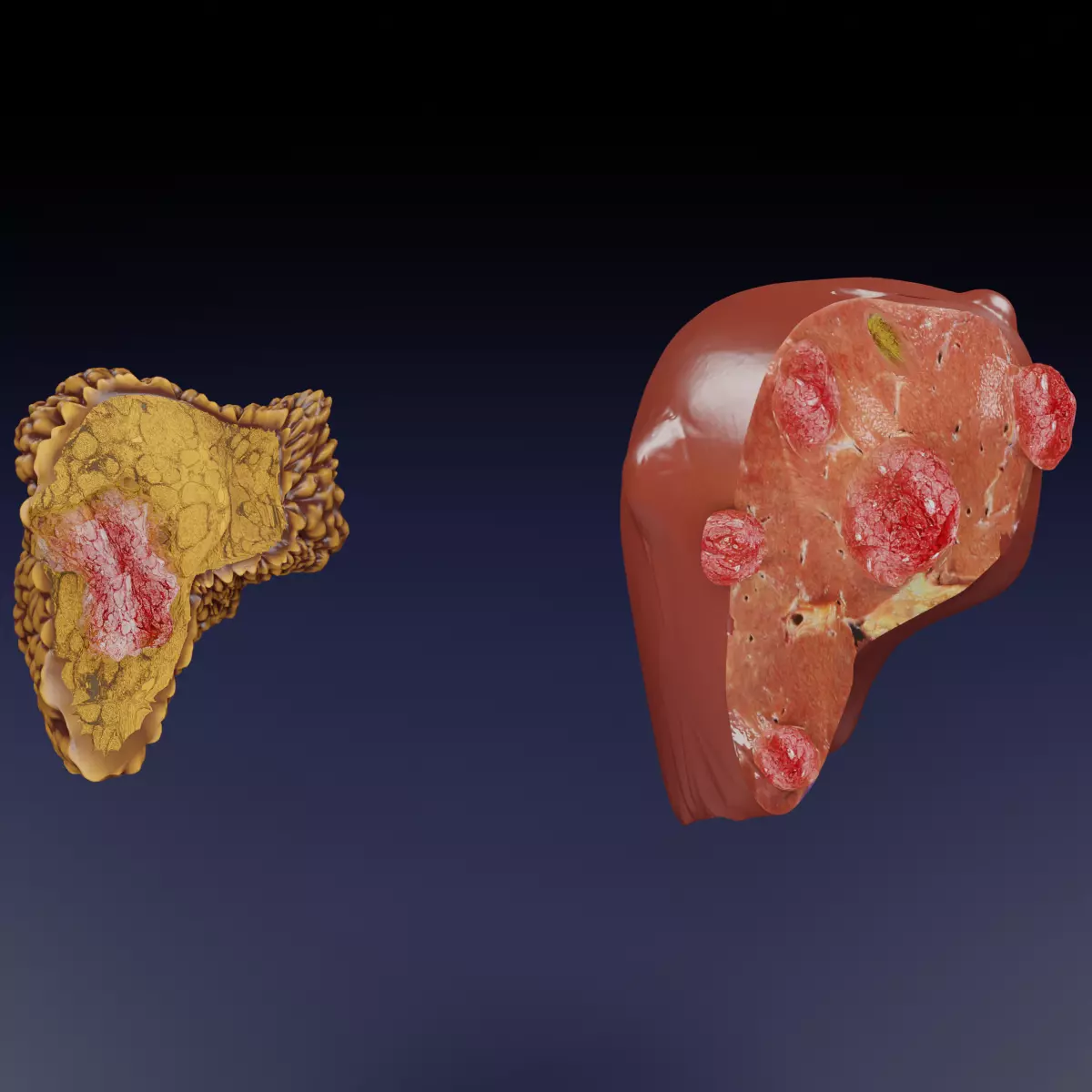 Liver cancer HCC vs Metastatic 3D model