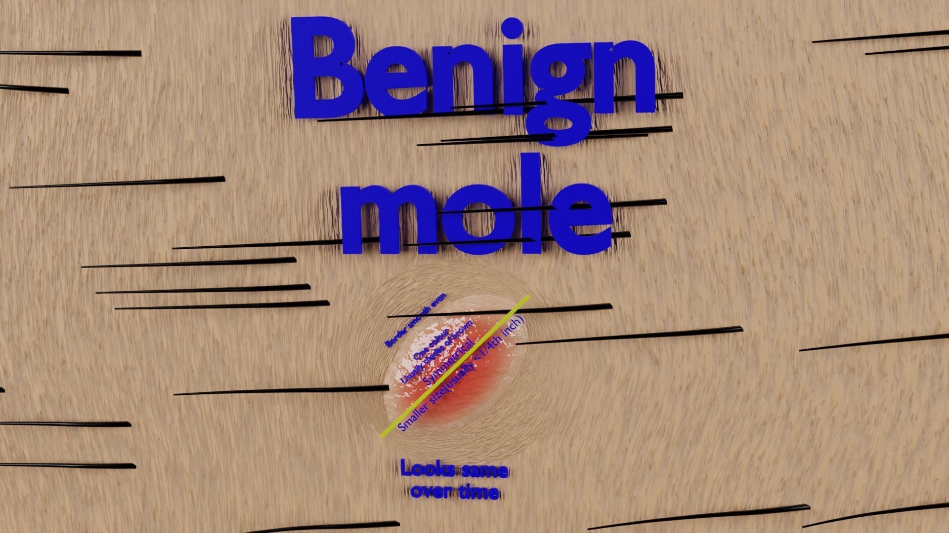 Mole nevus cancer Malignant melanoma differences 3D model_11