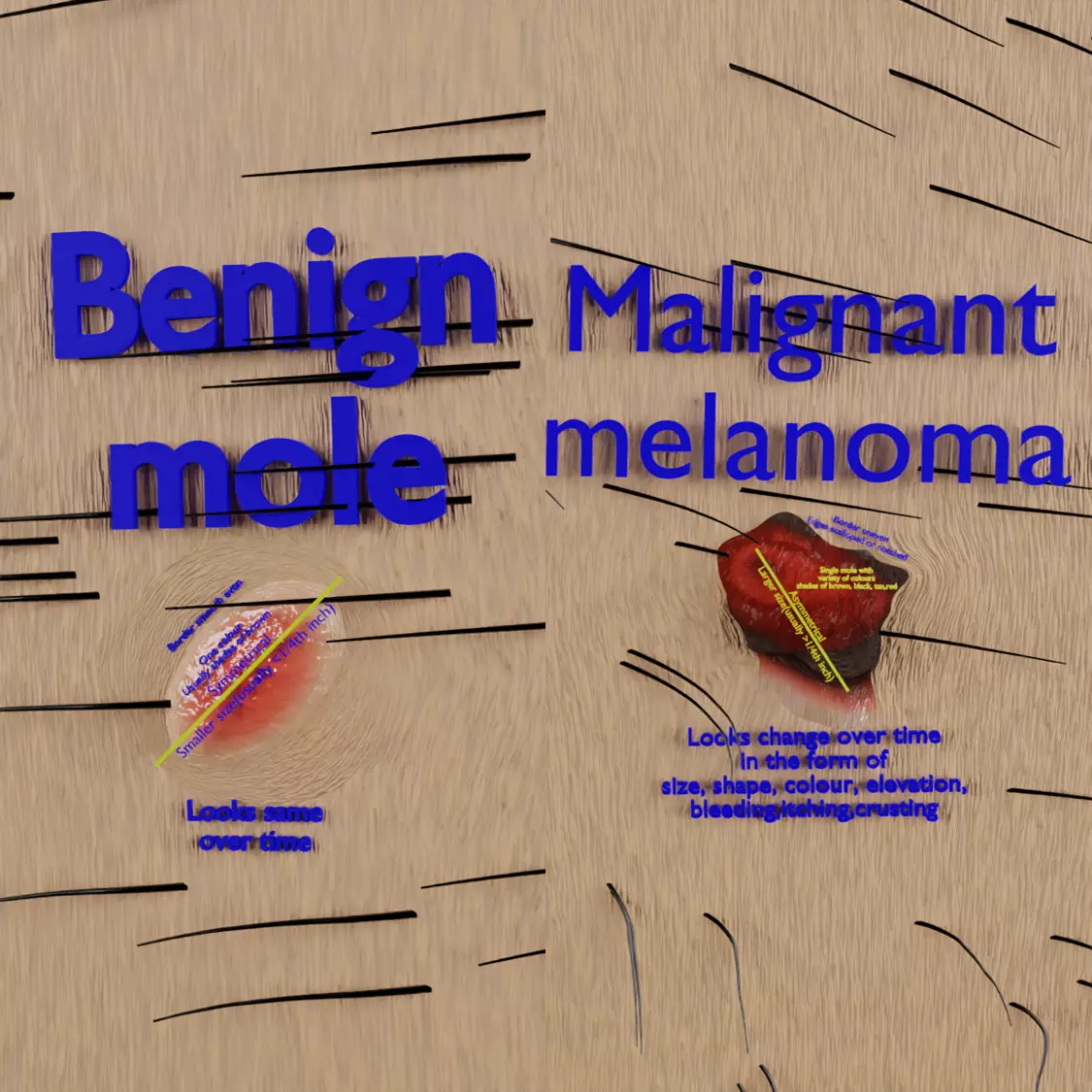 Mole nevus cancer Malignant melanoma differences 3D model_0