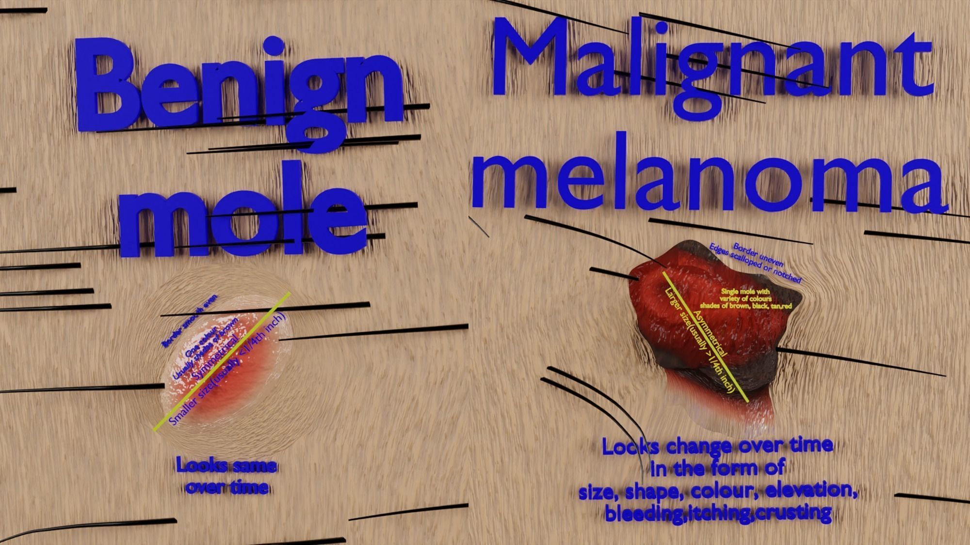 Mole nevus cancer Malignant melanoma differences 3D model_3