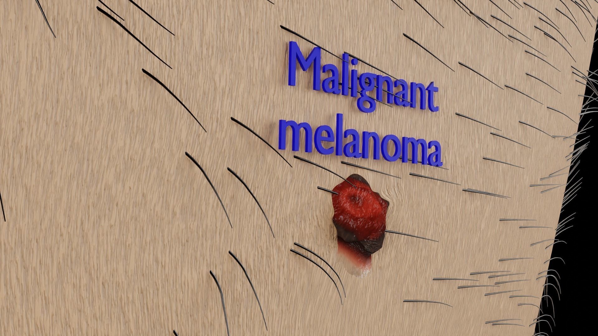 Mole nevus cancer Malignant melanoma differences 3D model_12