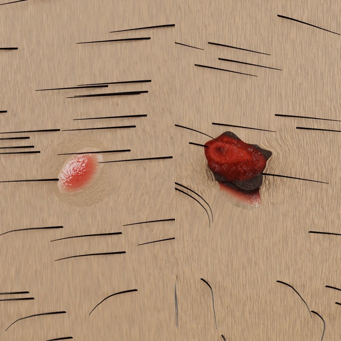 Mole nevus cancer Malignant melanoma differences 3D model_2