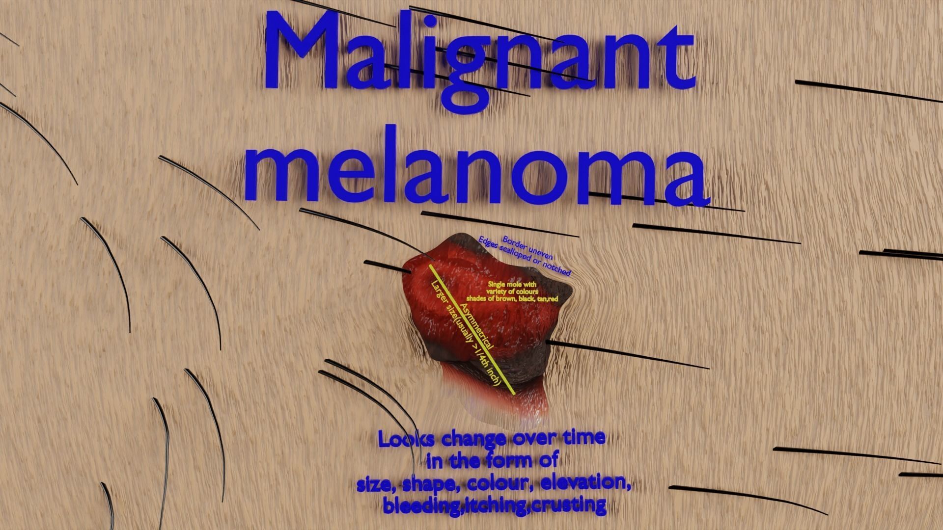 Mole nevus cancer Malignant melanoma differences 3D model_4