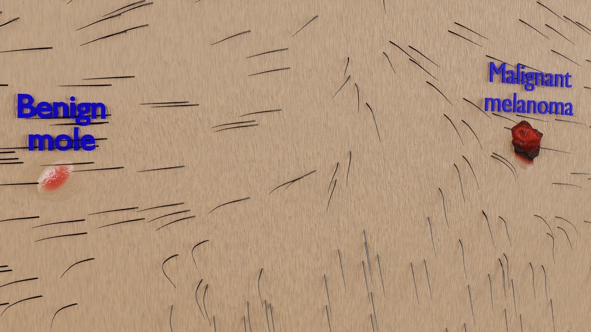 Mole nevus cancer Malignant melanoma differences 3D model_9