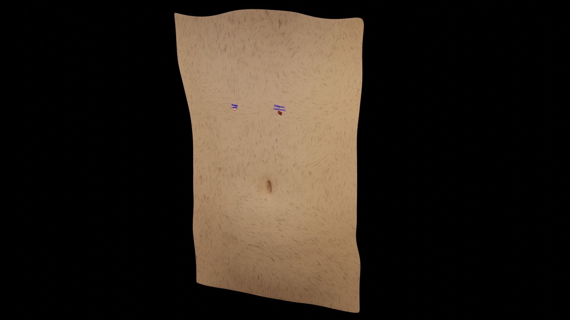 Mole nevus cancer Malignant melanoma differences 3D model_6