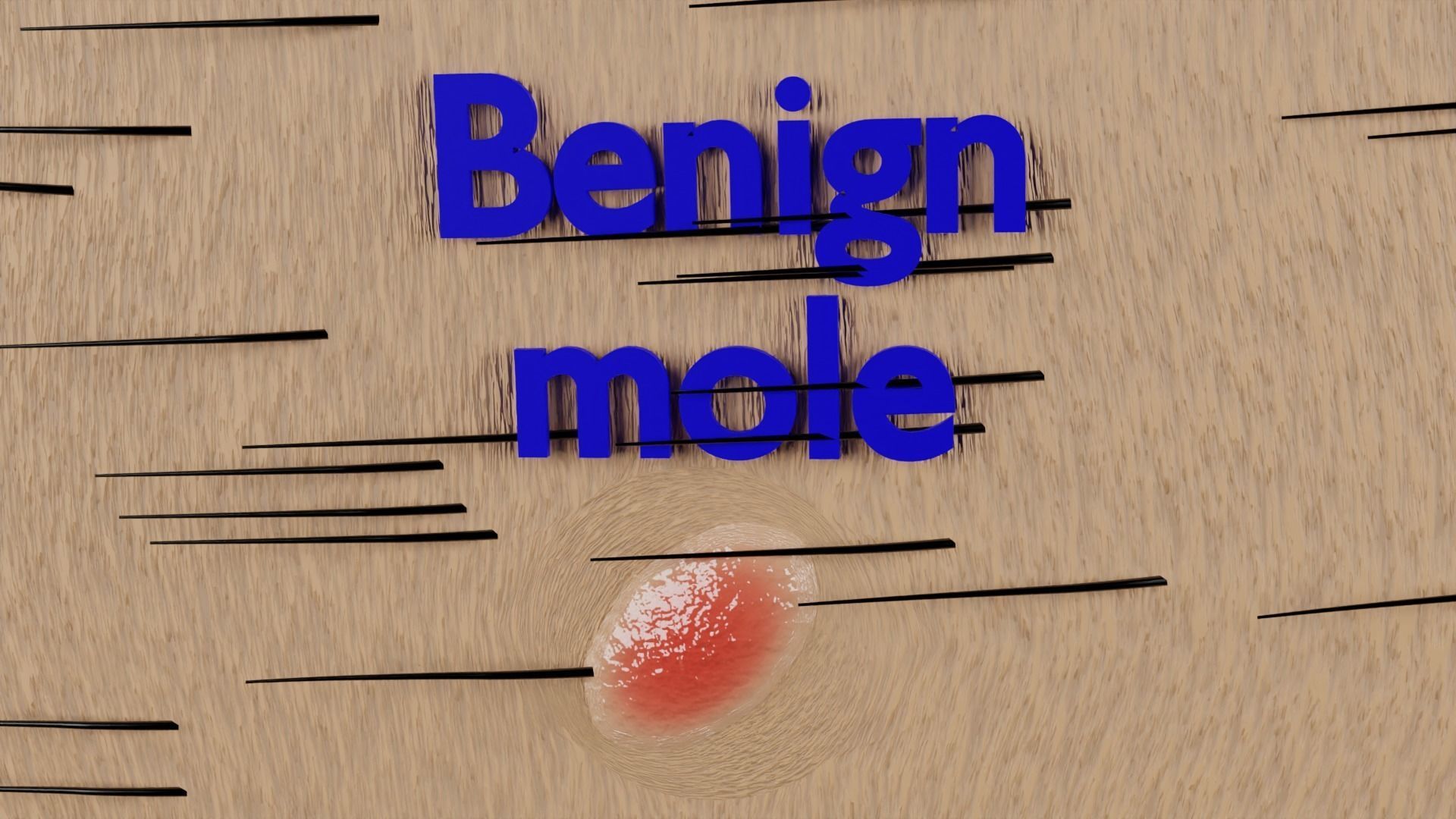 Mole nevus cancer Malignant melanoma differences 3D model_10