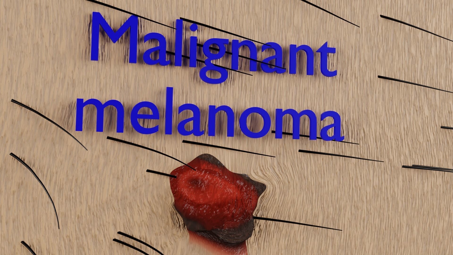 Mole nevus cancer Malignant melanoma differences 3D model_13