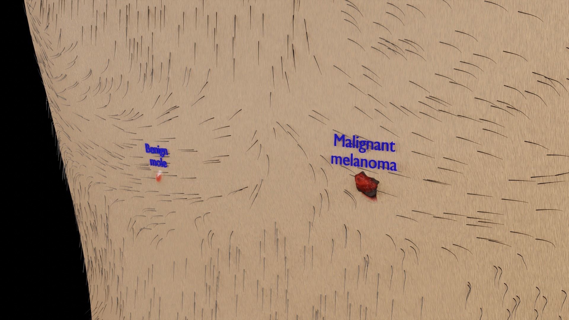 Mole nevus cancer Malignant melanoma differences 3D model_7