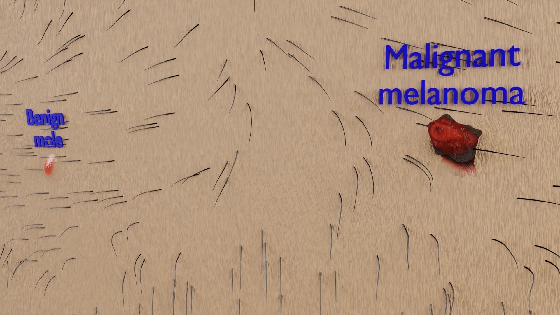 Mole nevus cancer Malignant melanoma differences 3D model_8