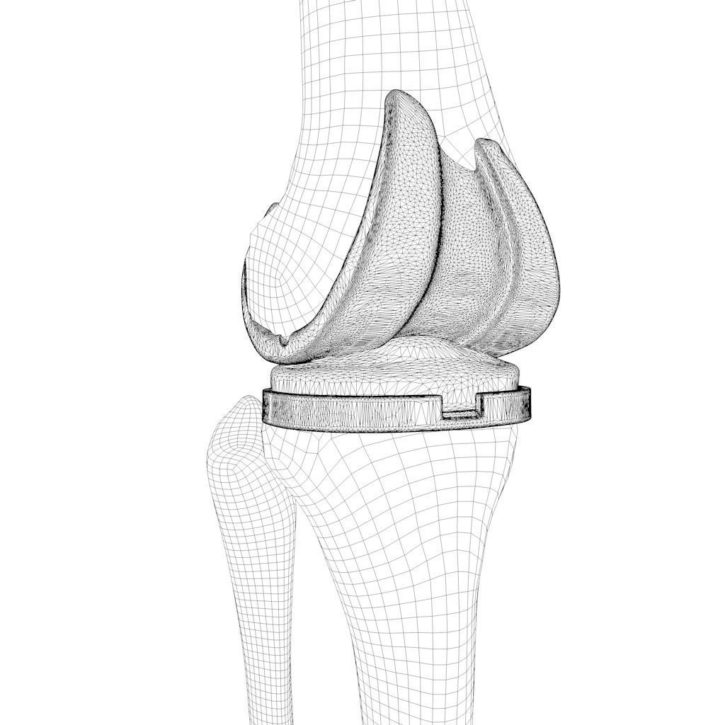 Knee Replacement Implant 3D model_8
